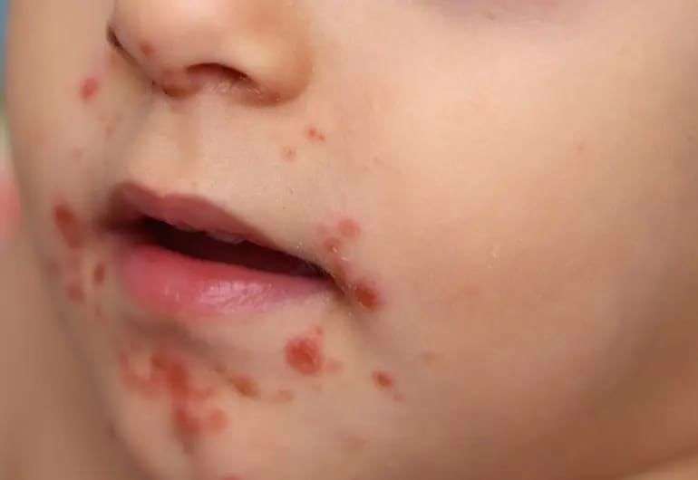 Van 71 brotes de coxsackie en 13 municipios del estado 